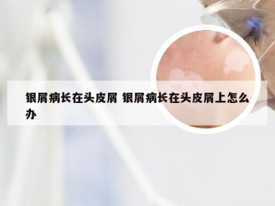 银屑病长在头皮屑 银屑病长在头皮屑上怎么办