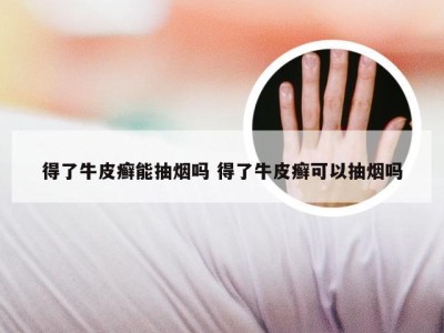 得了牛皮癣能抽烟吗 得了牛皮癣可以抽烟吗