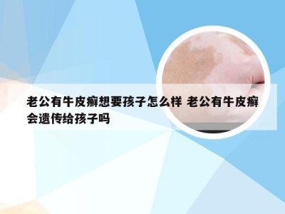 老公有牛皮癣想要孩子怎么样 老公有牛皮癣会遗传给孩子吗