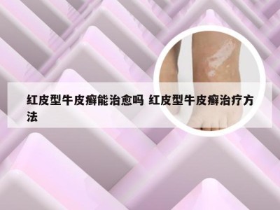 红皮型牛皮癣能治愈吗 红皮型牛皮癣治疗方法