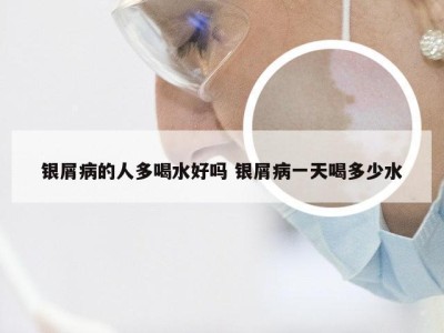 银屑病的人多喝水好吗 银屑病一天喝多少水