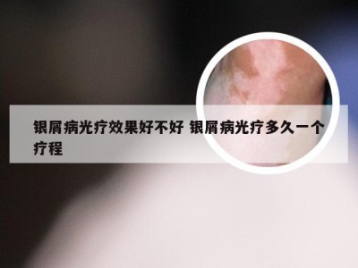 银屑病光疗效果好不好 银屑病光疗多久一个疗程