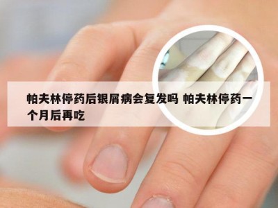 帕夫林停药后银屑病会复发吗 帕夫林停药一个月后再吃