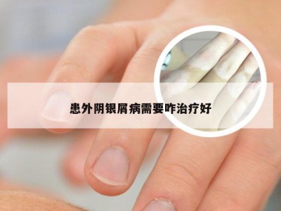 患外阴银屑病需要咋治疗好