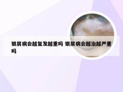 银屑病会越复发越重吗 银屑病会越治越严重吗