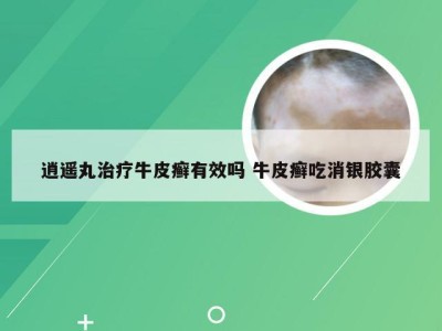 逍遥丸治疗牛皮癣有效吗 牛皮癣吃消银胶囊
