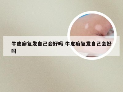 牛皮癣复发自己会好吗 牛皮癣复发自己会好吗