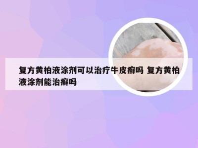 复方黄柏液涂剂可以治疗牛皮癣吗 复方黄柏液涂剂能治癣吗