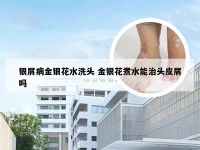 银屑病金银花水洗头 金银花煮水能治头皮屑吗