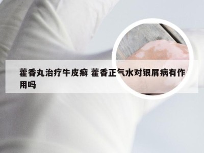 藿香丸治疗牛皮癣 藿香正气水对银屑病有作用吗