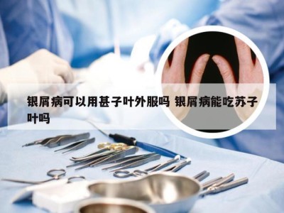 银屑病可以用甚子叶外服吗 银屑病能吃苏子叶吗