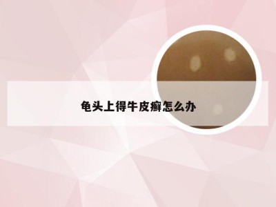 龟头上得牛皮癣怎么办