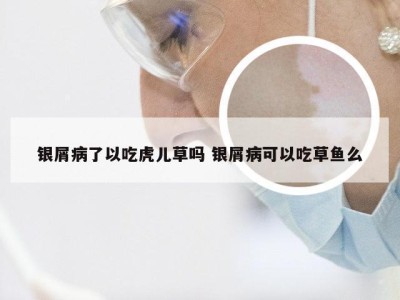 银屑病了以吃虎儿草吗 银屑病可以吃草鱼么