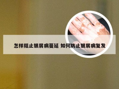 怎样阻止银屑病蔓延 如何防止银屑病复发