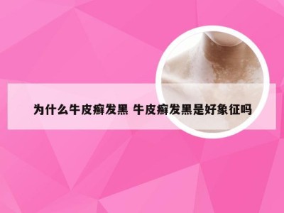 为什么牛皮癣发黑 牛皮癣发黑是好象征吗