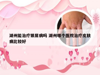 湖州能治疗银屑病吗 湖州哪个医院治疗皮肤病比较好