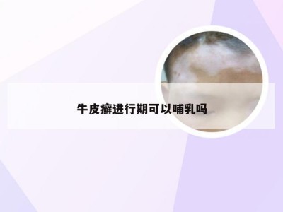 牛皮癣进行期可以哺乳吗