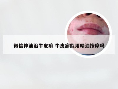 微信神油治牛皮癣 牛皮癣能用精油按摩吗