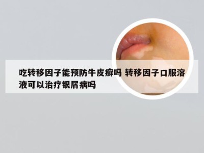 吃转移因子能预防牛皮癣吗 转移因子口服溶液可以治疗银屑病吗