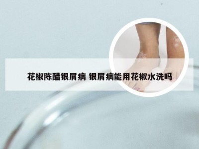 花椒陈醋银屑病 银屑病能用花椒水洗吗