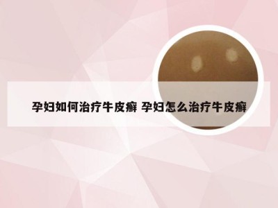 孕妇如何治疗牛皮癣 孕妇怎么治疗牛皮癣