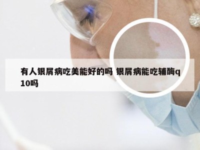 有人银屑病吃美能好的吗 银屑病能吃辅酶q10吗