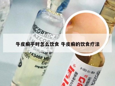 牛皮癣平时怎么饮食 牛皮癣的饮食疗法