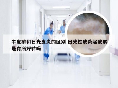牛皮癣和日光皮炎的区别 日光性皮炎起皮屑是有所好转吗