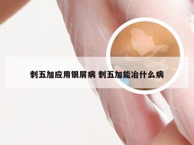 刺五加应用银屑病 刺五加能冶什么病