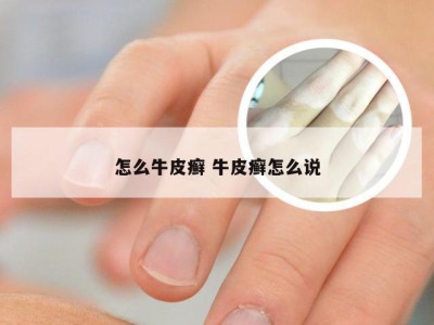 怎么牛皮癣 牛皮癣怎么说