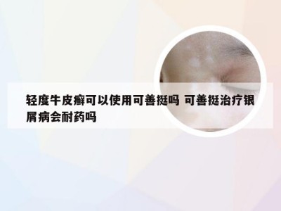 轻度牛皮癣可以使用可善挺吗 可善挺治疗银屑病会耐药吗