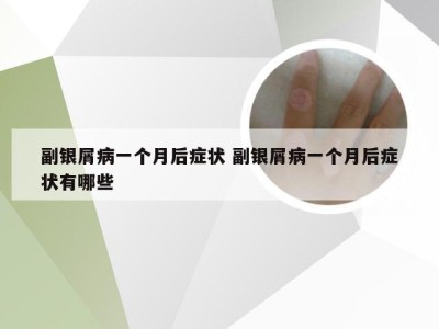 副银屑病一个月后症状 副银屑病一个月后症状有哪些