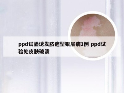 ppd试验诱发脓疱型银屑病1例 ppd试验处皮肤破溃