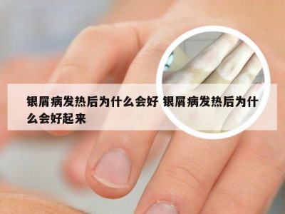 银屑病发热后为什么会好 银屑病发热后为什么会好起来