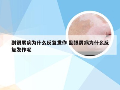 副银屑病为什么反复发作 副银屑病为什么反复发作呢
