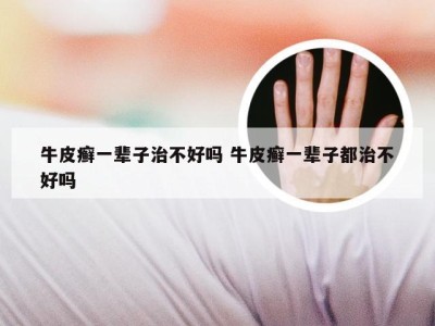 牛皮癣一辈子治不好吗 牛皮癣一辈子都治不好吗