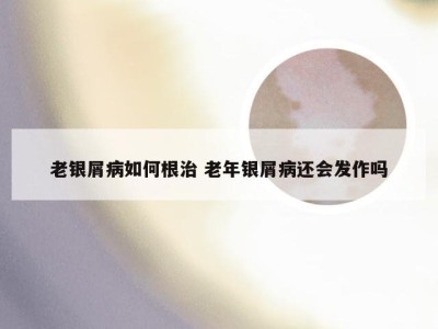 老银屑病如何根治 老年银屑病还会发作吗