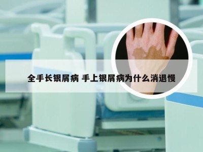 全手长银屑病 手上银屑病为什么消退慢