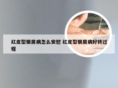 红皮型银屑病怎么安慰 红皮型银屑病好转过程