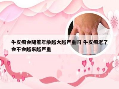 牛皮癣会随着年龄越大越严重吗 牛皮癣老了会不会越来越严重