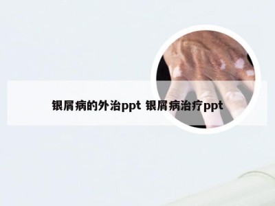 银屑病的外治ppt 银屑病治疗ppt
