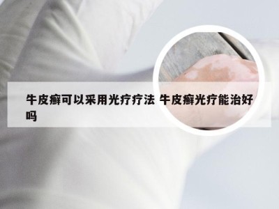 牛皮癣可以采用光疗疗法 牛皮癣光疗能治好吗
