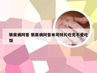 银屑病阿普 银屑病阿普米司特片吃完不爱吃饭