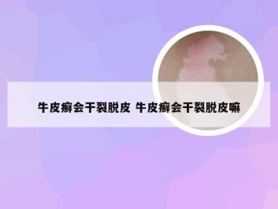 牛皮癣会干裂脱皮 牛皮癣会干裂脱皮嘛