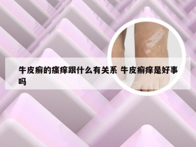 牛皮癣的瘙痒跟什么有关系 牛皮癣痒是好事吗