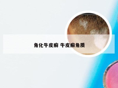 角化牛皮癣 牛皮癣角质