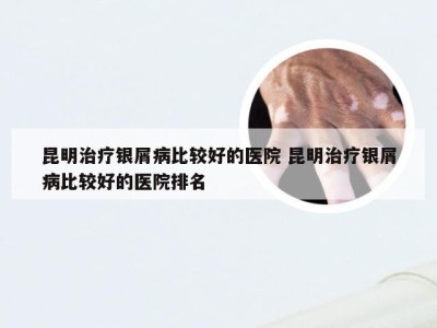 昆明治疗银屑病比较好的医院 昆明治疗银屑病比较好的医院排名