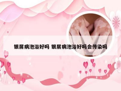 银屑病泡浴好吗 银屑病泡浴好吗会传染吗