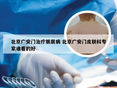 北京广安门治疗银屑病 北京广安门皮肤科专家谁看的好