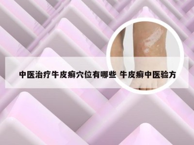 中医治疗牛皮癣穴位有哪些 牛皮癣中医验方